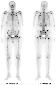 What are normal and abnormal bone scan results?
